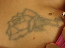 Laser Tattoo Removal