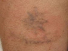 Laser Tattoo Removal