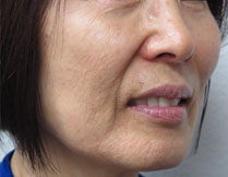 Fractional Resurfacing