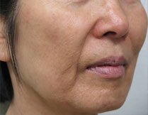 Fractional Resurfacing