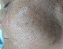 Fractional Resurfacing