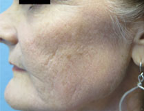 Fractional Resurfacing