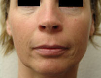 Fractional Resurfacing