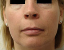 Fractional Resurfacing