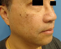 Fractional Resurfacing