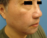 Fractional Resurfacing