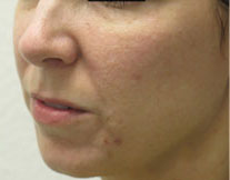 Fractional Resurfacing