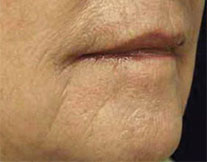 Fractional Resurfacing