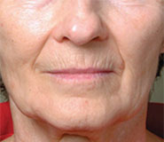 Fractional Resurfacing