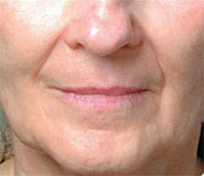 Fractional Resurfacing