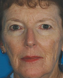 Fractional Resurfacing