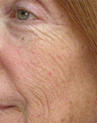 Fractional Resurfacing