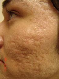 Fractional Resurfacing