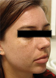 IPL/FotoFacial™