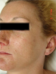 IPL/FotoFacial™