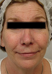 IPL/FotoFacial™