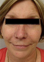 IPL/FotoFacial™