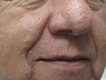 Facial Capillaries Treatment