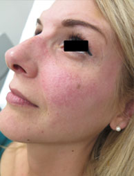 Facial Capillaries Treatment