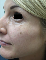 Facial Capillaries Treatment