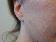 Mole Removal