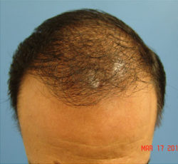 Hair Transplant