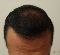 Hair Transplant