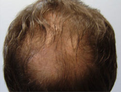 Hair Transplant