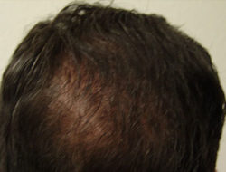 Hair Transplant