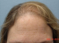 Hair Transplant