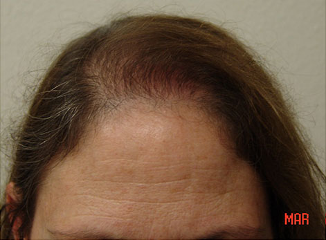 Hair Transplant