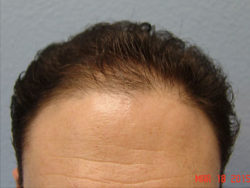 Hair Transplant