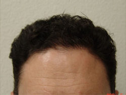 Hair Transplant