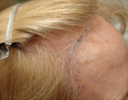 Hair Transplant