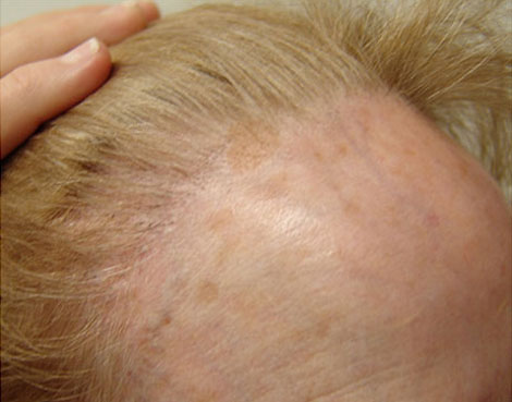 Hair Transplant