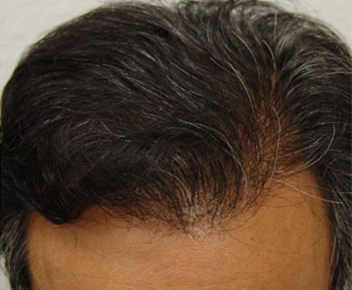 Hair Transplant