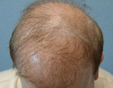 Hair Transplant