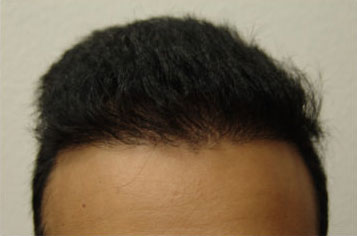 Hair Transplant