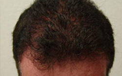 Hair Transplant