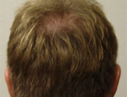 Hair Transplant