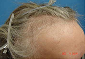 Hair Transplant