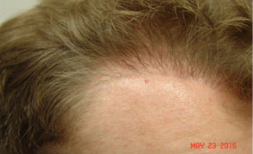 Hair Transplant