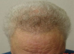 Hair Transplant