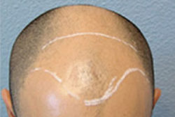 Hair Transplant