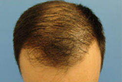 Hair Transplant