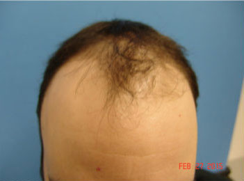 Hair Transplant