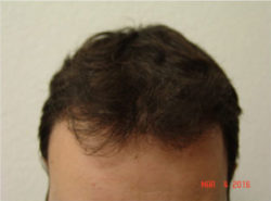 Hair Transplant