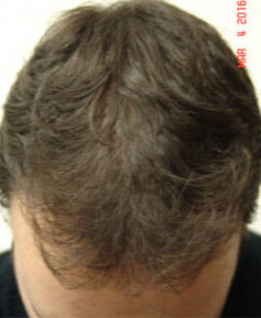 Hair Transplant