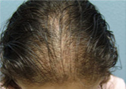 Hair Transplant