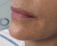 Dermal Fillers